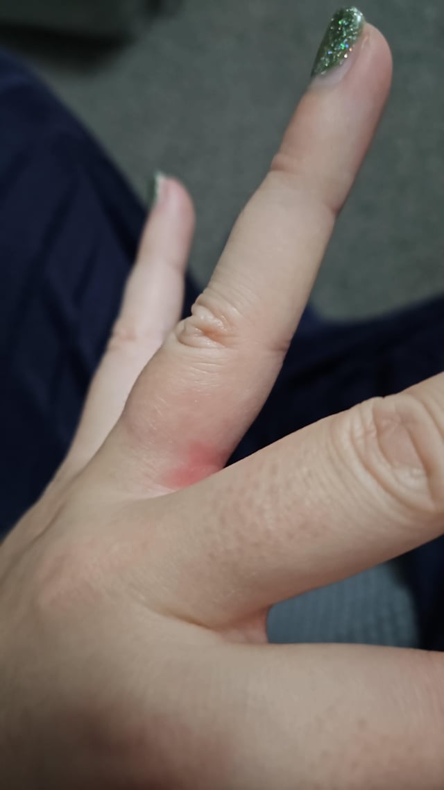 我的订婚/结婚戒指导致我的手指变红，有时皮肤会开始剥落，引起疼痛。我戴这些戒指已经很长时间了，这只是开始